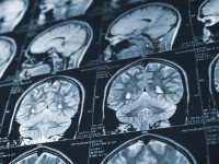 Επτά νευρολογικές επιπτώσεις του κορονοϊού – Πώς επηρεάζεται ο εγκέφαλος