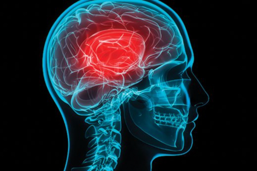 “Αγγειακά εγκεφαλικά επεισόδια – Από την πρόληψη στη θεραπεία”