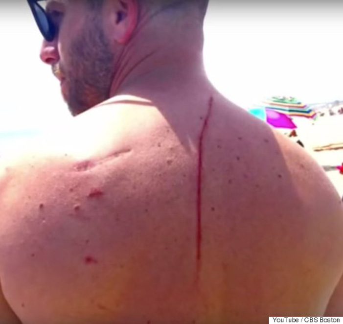 Πώς η επίθεση από καρχαρία του έσωσε τη ζωή