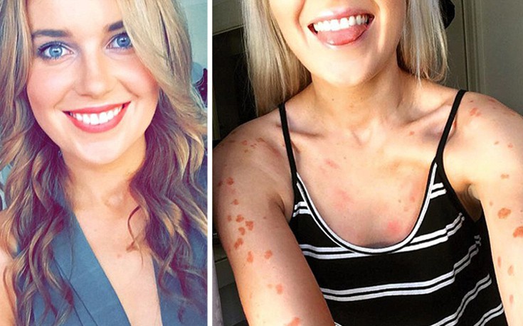 Η καθημερινή μάχη μιας 22χρονης με την επώδυνη πάθηση στο δέρμα της