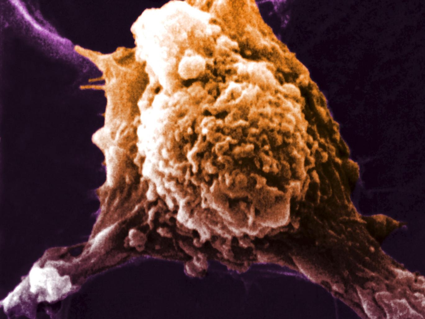 Σημαντική ανακάλυψη για τον καρκίνο – Βρήκαν εμβόλιο χωρίς παρενέργειες