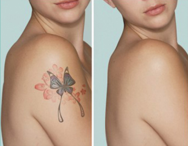 Θέλεις να απαλλαγείς από ένα ανεπιθύμητο τατουάζ;