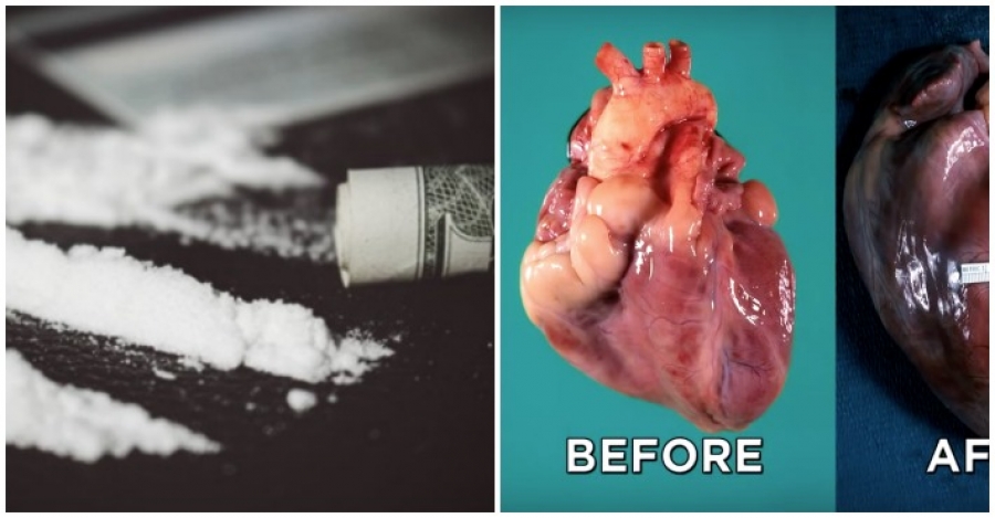 Τι παθαίνει η καρδιά μετά από μακροχρόνια χρήση κοκαΐνης