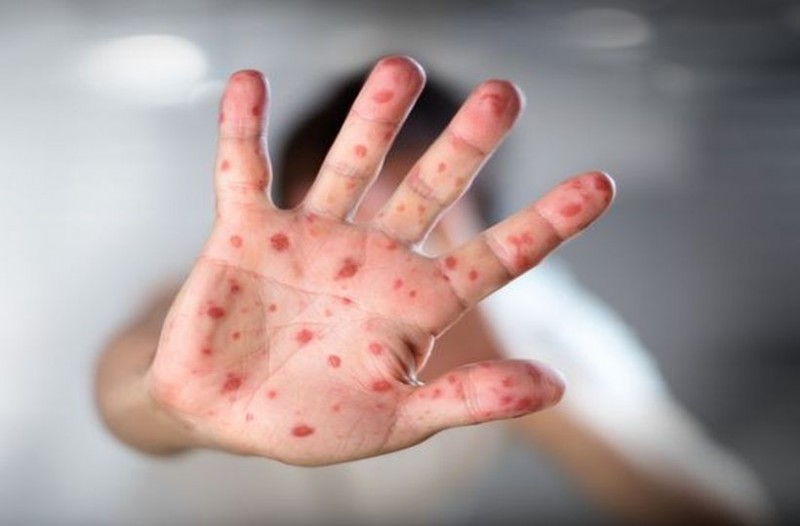 ΚΕΕΛΠΝΟ: Συνολικά 1.185 κρούσματα ιλαράς έχουν καταγραφεί στην Ελλάδα