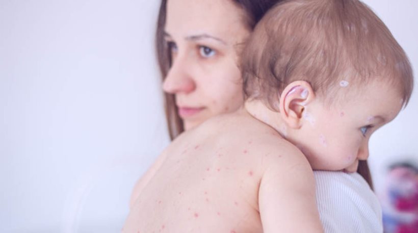 Ένα βρέφος 11 μηνών το πρώτο θύμα της ιλαράς στην Ελλάδα
