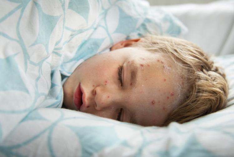 Τριάντα νέα κρούσματα ιλαράς σε μία εβδομάδα, ανεμβολίαστα 350.000 παιδιά