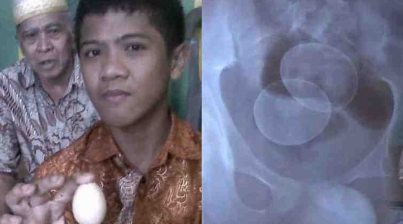 Οι επιστήμονες τρελάθηκαν: 14χρονος «γεννά» αυγά στην Ινδονησία