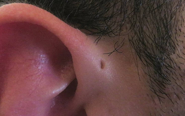 Αν έχετε αυτές τις μικρές τρυπίτσες γύρω από τα αυτιά…μην ανησυχείτε