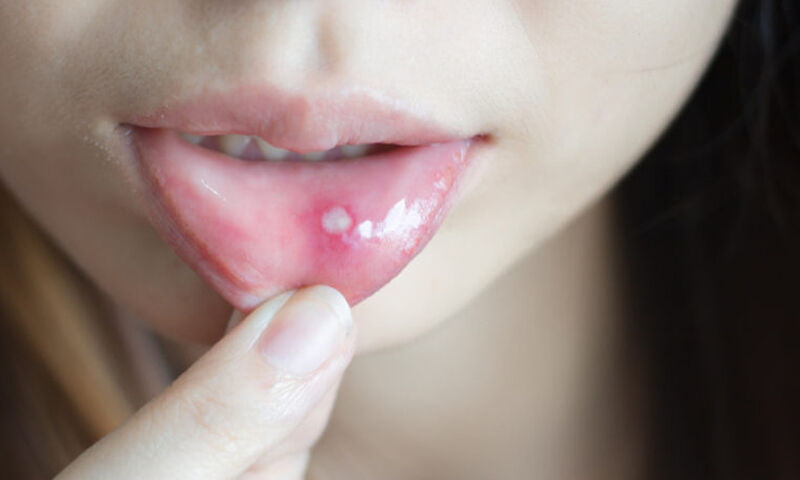 Επτά κίνδυνοι για την υγεία που αποτυπώνονται στο στόμα