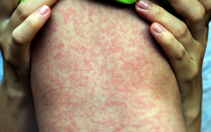Εξαπλώνεται η ιλαρά στη Νέα Ζηλανδία, πάνω από χίλια τα επιβεβαιωμένα κρούσματα