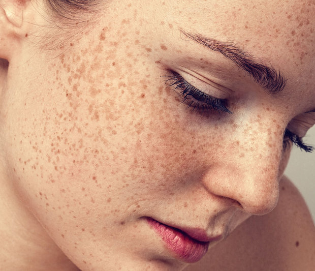 Πώς θα εξαφανίσετε τις πανάδες στο πρόσωπο με φυσικές θεραπείες
