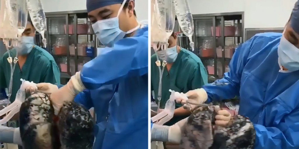 Χειρουργός στην Κίνα δείχνει πώς μοιάζουν οι πνεύμονες καπνιστή επί 30 χρόνια (βίντεο)