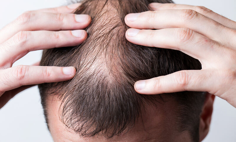 Φαλάκρα: Ποιες είναι οι αιτίες απώλειας των μαλλιών