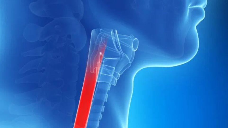 Ηλεκτρονική «μύτη»  ανιχνεύει μέσω αναπνοής τον πρόδρομο του καρκίνου του οισοφάγου