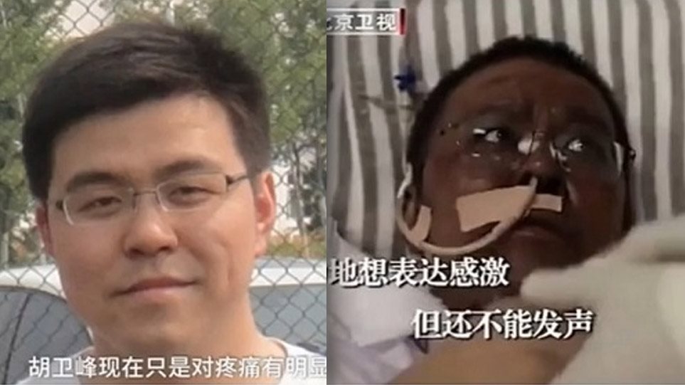 Κορωνοϊός – Κίνα: Ο γιατρός της Ουχάν που μαύρισε το δέρμα του λόγω της θεραπείας πέθανε