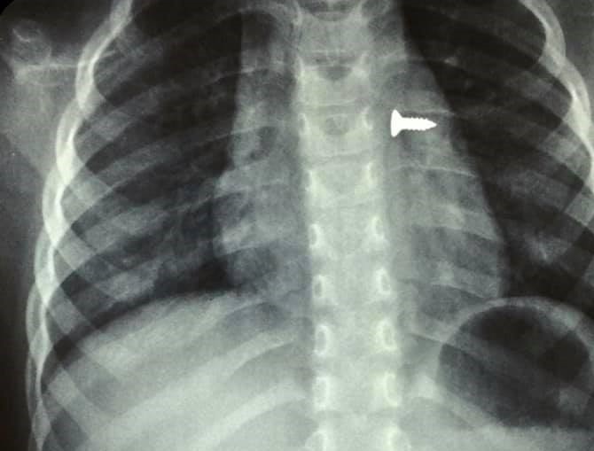 Κρήτη: Ανήλικο παιδί κατάπιε βίδα που κατέληξε στα πνευμόνια του (φωτο)