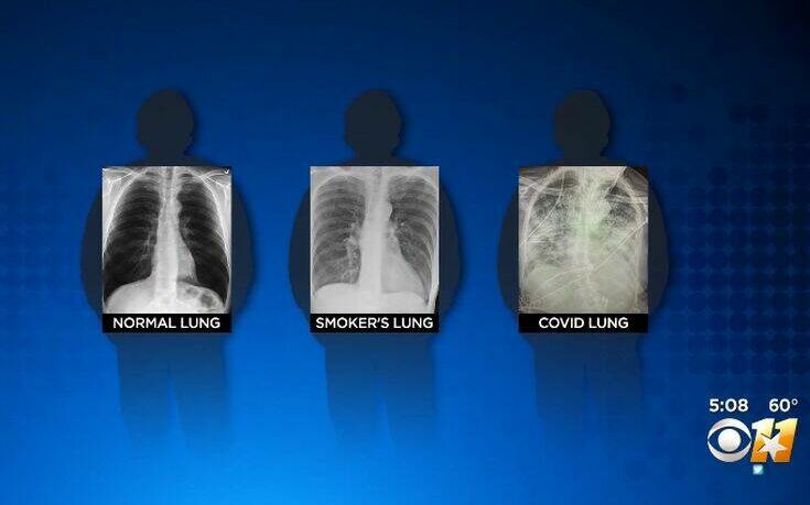 Έτσι είναι οι πνεύμονες ενός ασθενούς με κορονοϊό, ενός καπνιστή και ενός υγιούς ανθρώπου