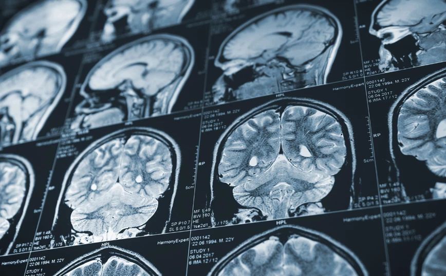 Επτά νευρολογικές επιπτώσεις του κορονοϊού – Πώς επηρεάζεται ο εγκέφαλος