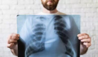 Καρκίνος του πνεύμονα: Γιατί το 41% των ασθενών διαγιγνώσκονται σε προχωρημένο στάδιο￼