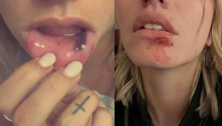Γλυφάδα: Συγκλονίζουν οι φωτογραφίες από τα χτυπήματα που δέχτηκε το μοντέλο από τον πρώην σύντροφό της
