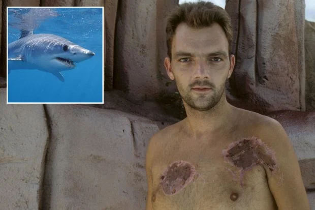 «Έτσι σώθηκα από τα δόντια του καρχαρία» – Συγκλονιστική μαρτυρία ανθρώπου που ζει με 300 ράμματα στο σώμα του (φωτο)
